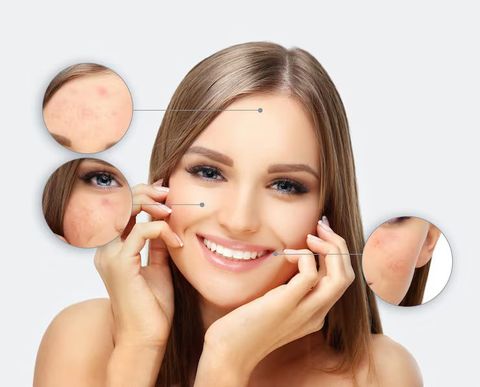 How to Get Rid of Acne: What Actually Works Guide